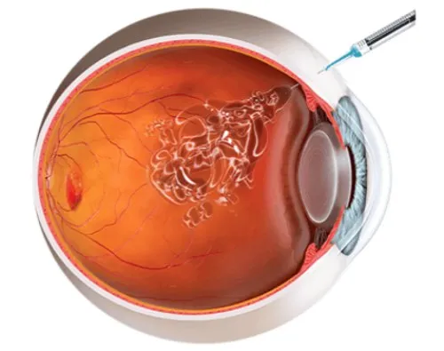 Inyeccion-intravitrea-DMAE