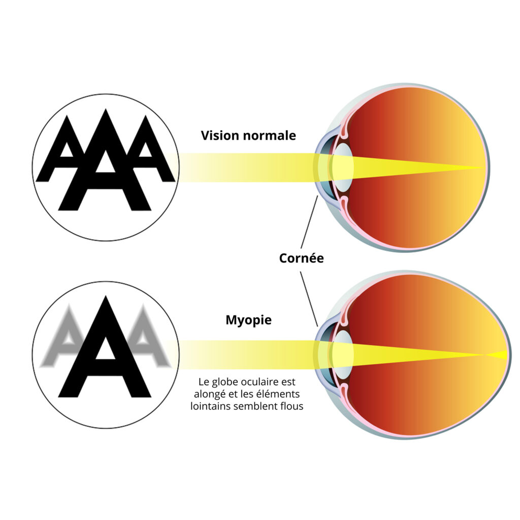 MYOPIE-VISIONSUD2