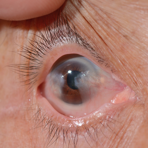 Chirurgie-du-glaucome