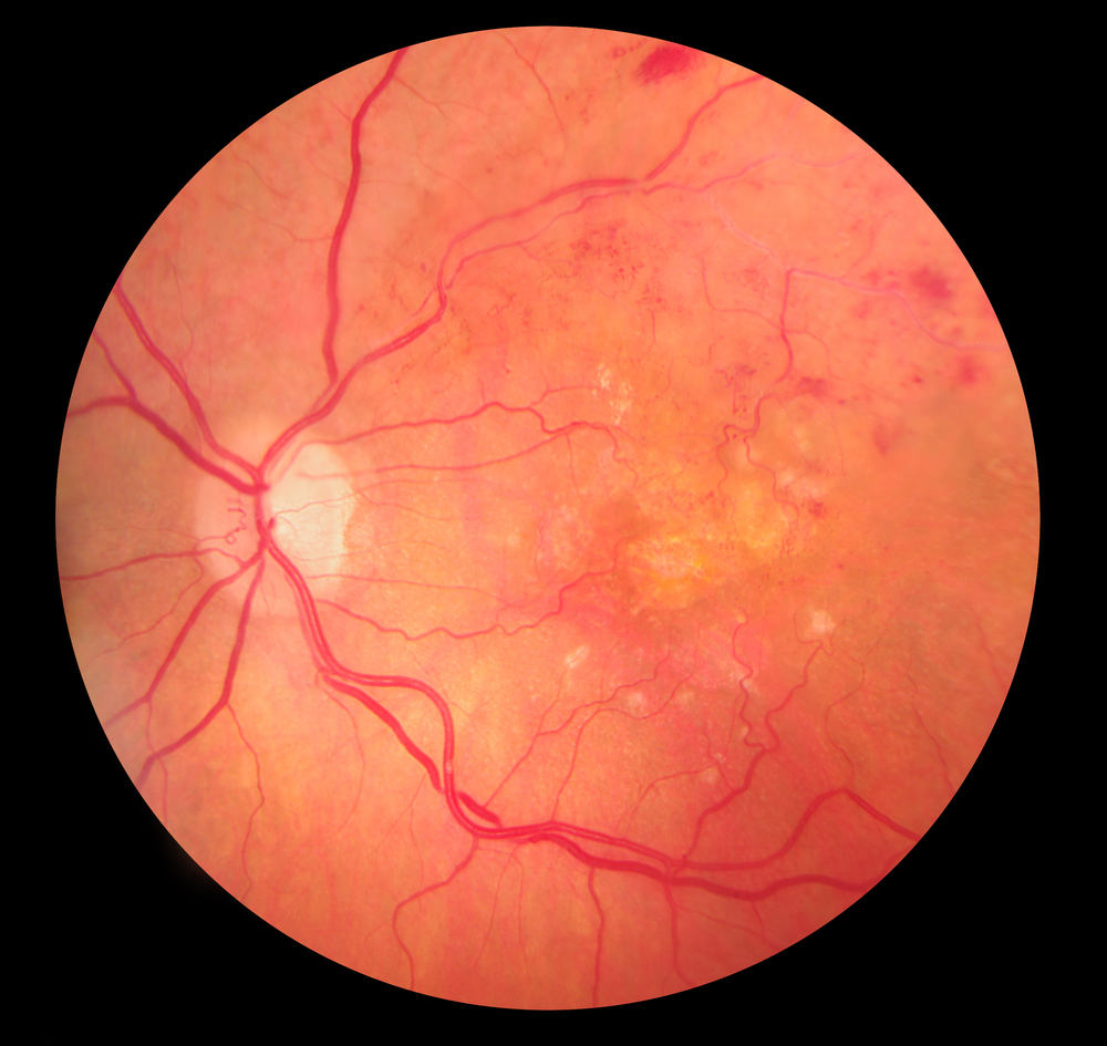 Occlusion veineuse de la rétine