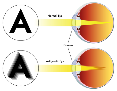 Astigmatisme