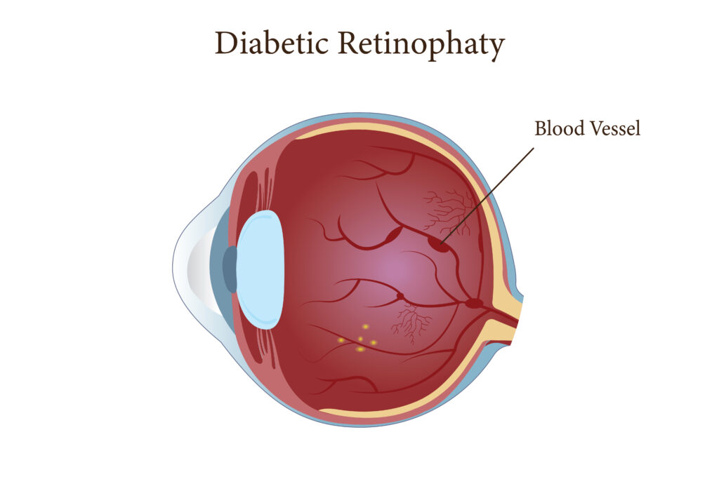 RETINOPATHIE-DIABETIQUE